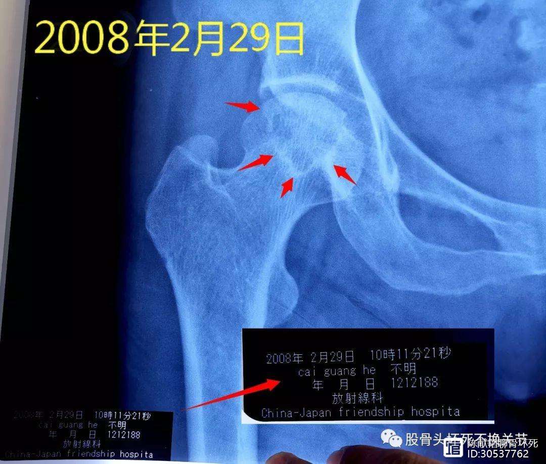 南平人工骨头医保报销多少(人工骨头医保报销多少比例)
